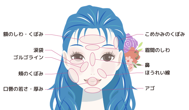 Hyaluronic Acid Treatment Areas