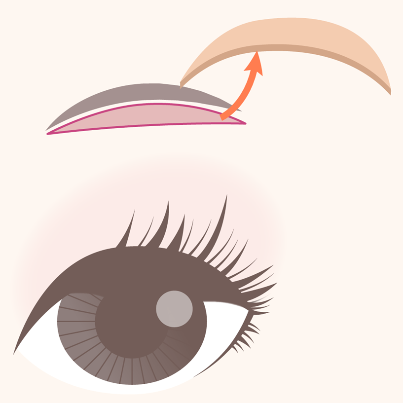 Image of Upper Eyelid Sagging Removal