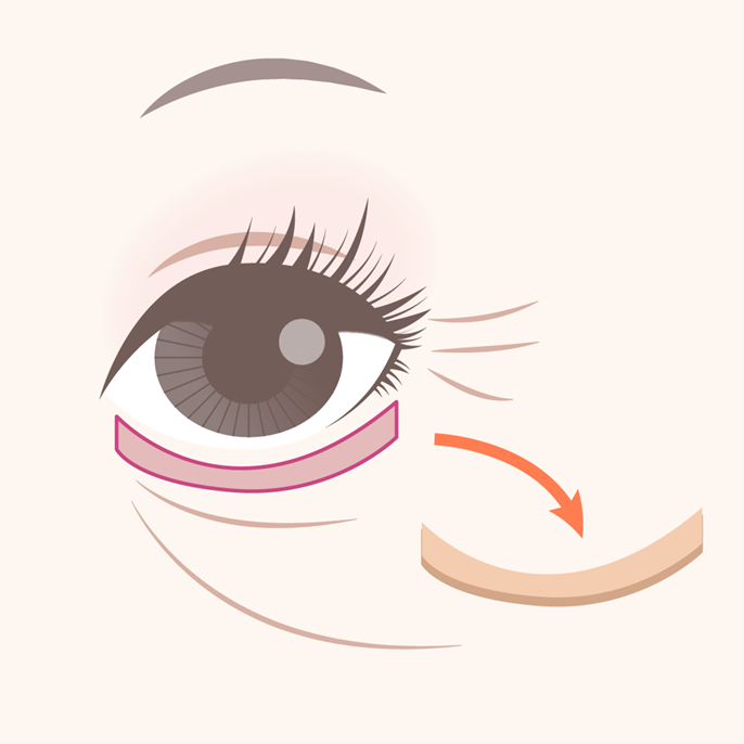 Image of Under-Eye Sagging Removal