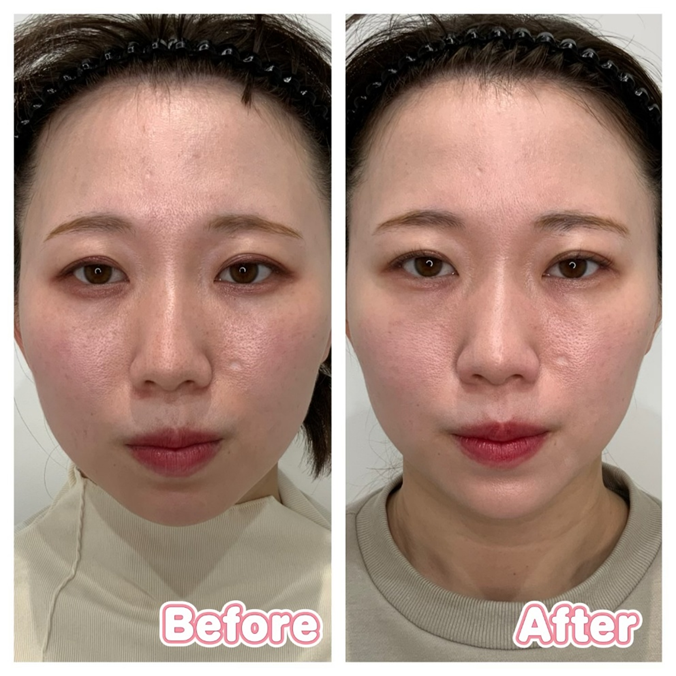 Jaw Contouring Case Studies before after1