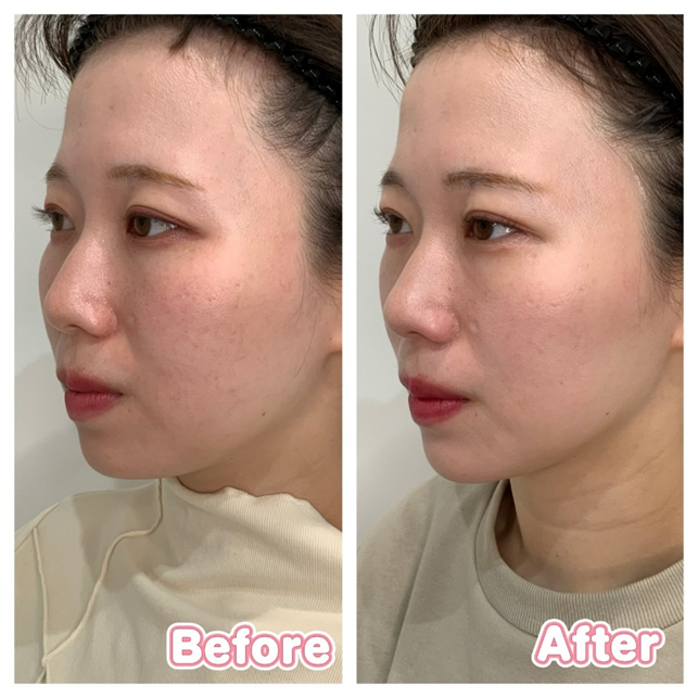 Jaw Contouring Case Studies before after2