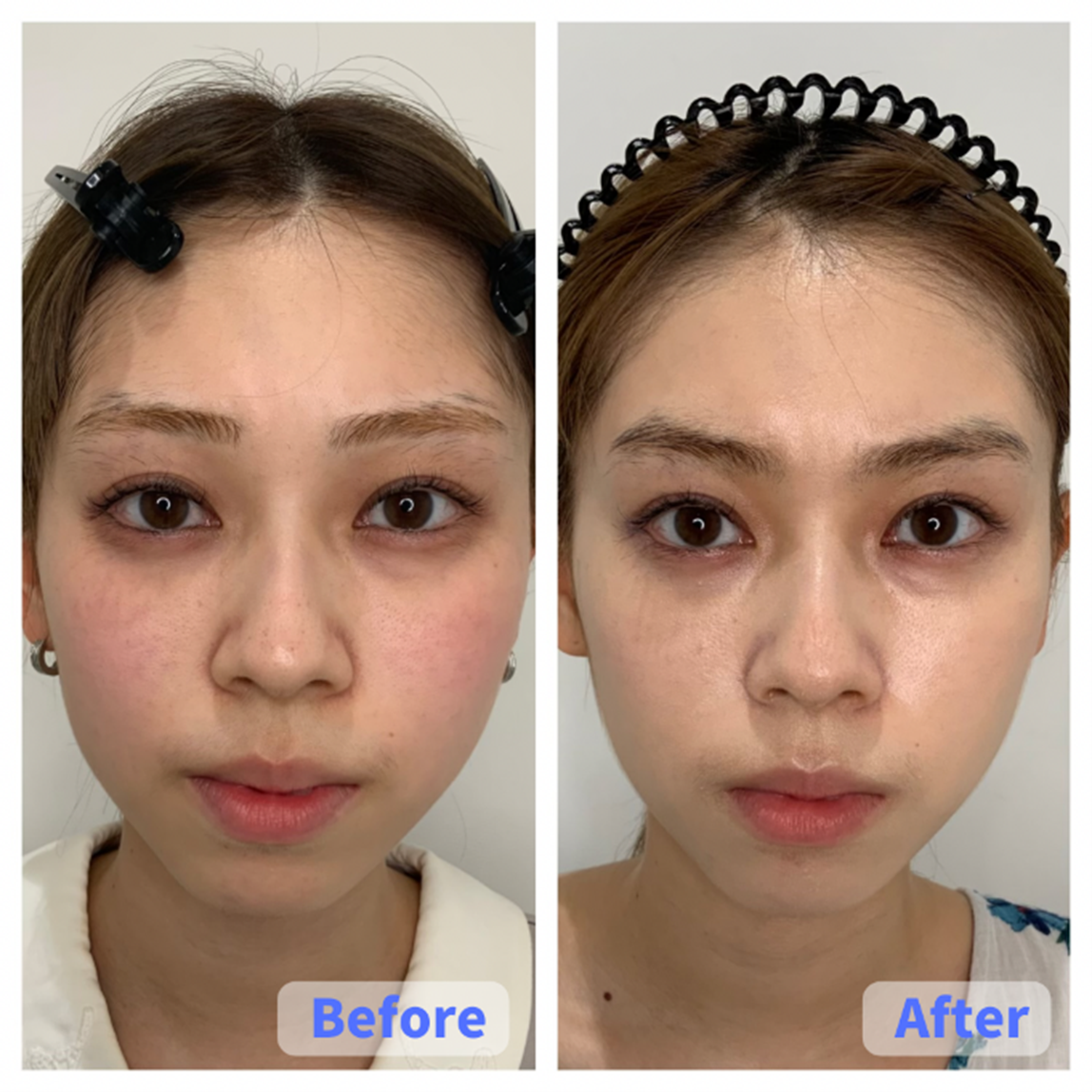 Case 1 (Full Face)