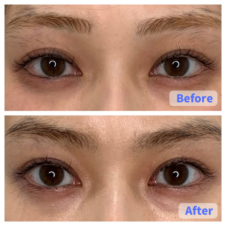 Case 1 (Eye Area)