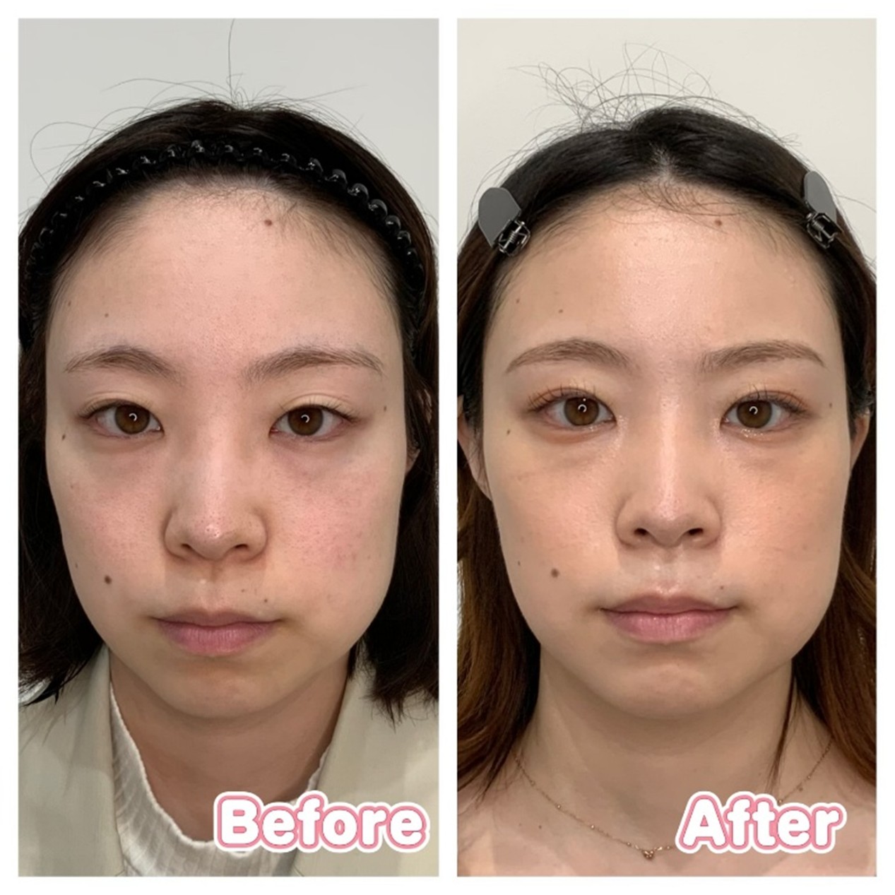Case 2(Full Face)
