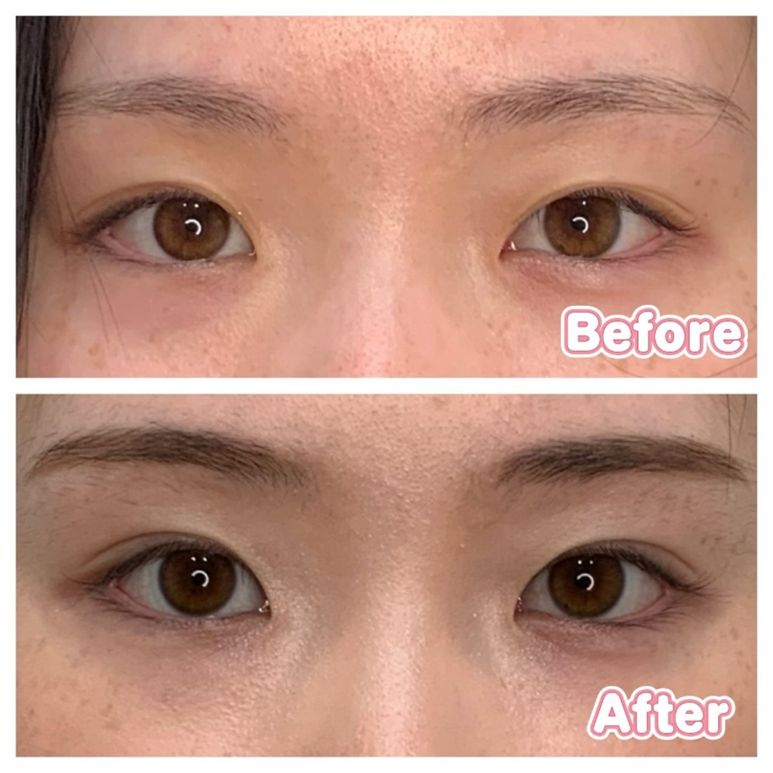 Case 2 (Eye Area)