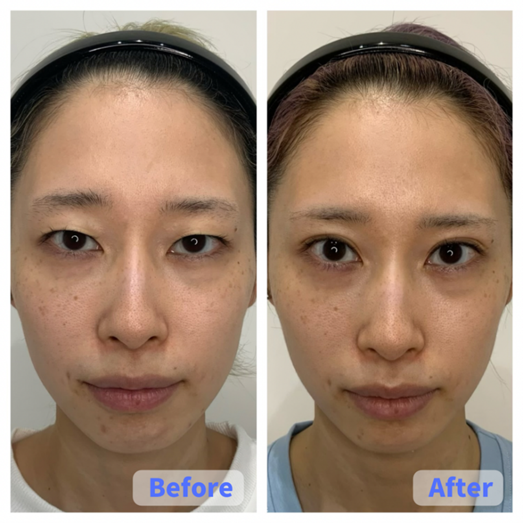 Case 3(Full Face)