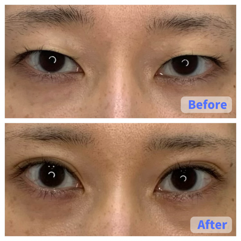 Case 3 (Eye Area)
