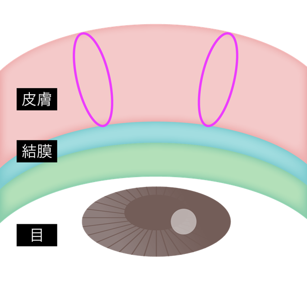Standard Double Buried Suture Method