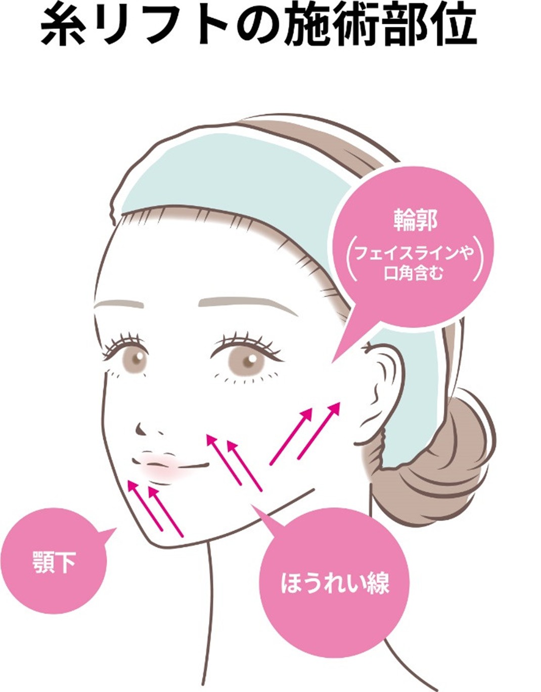 Thread Lift Treatment Areas