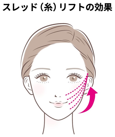 Thread Lift Effects