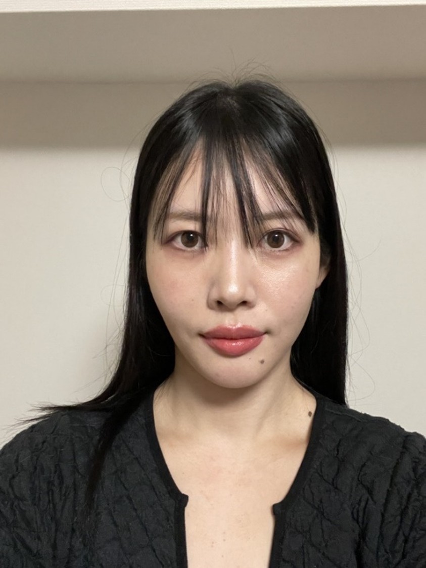 Front view photo of a woman one week after treatment
