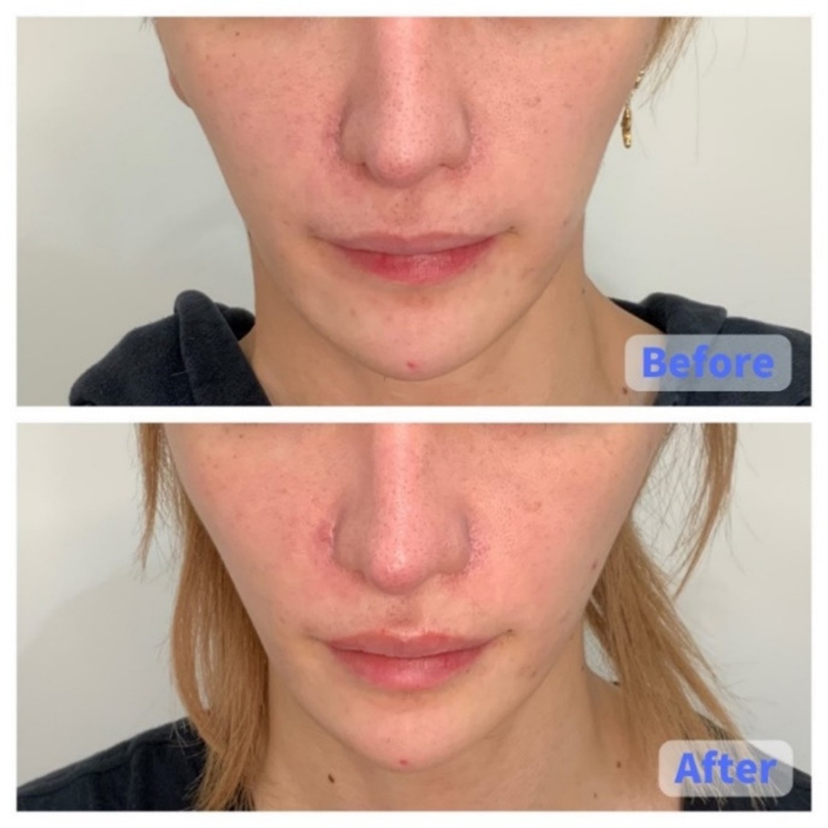 Thread Lift Case Before and After