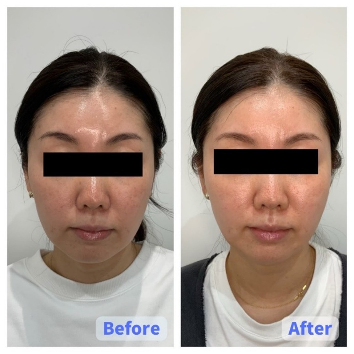 Thread Lift Case 2: Before and After