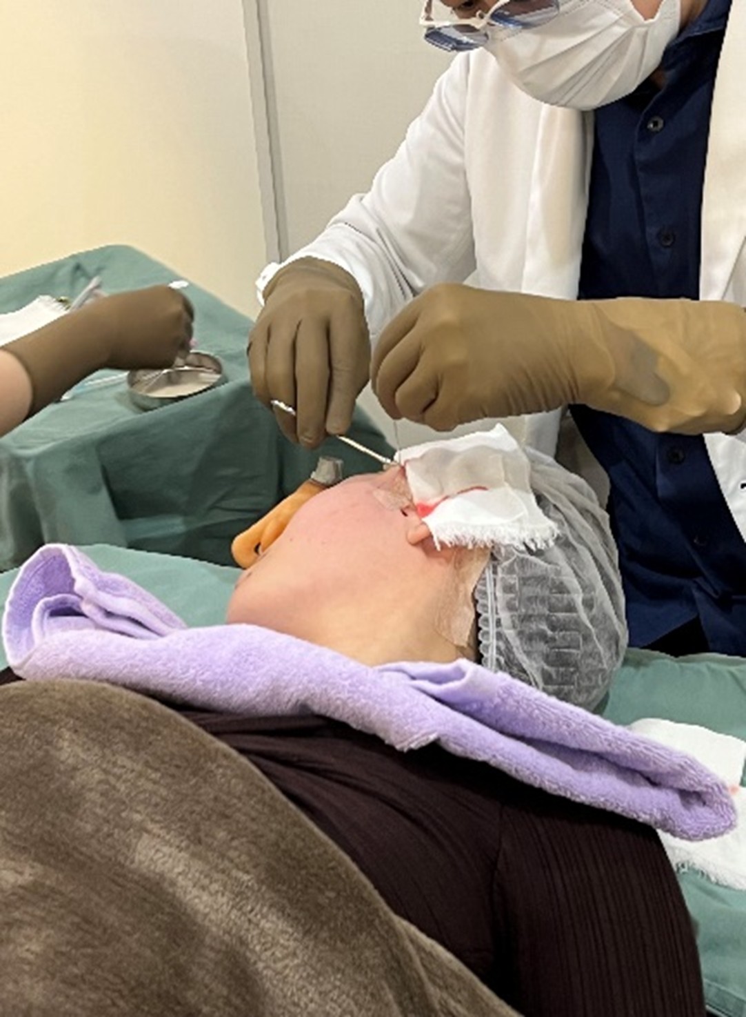Thread Lift Procedure