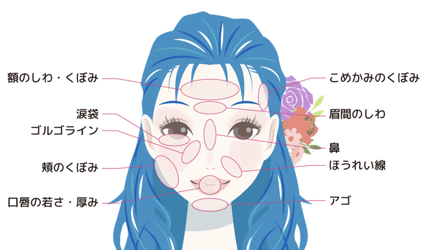 Hyaluronic Acid Treatment Areas