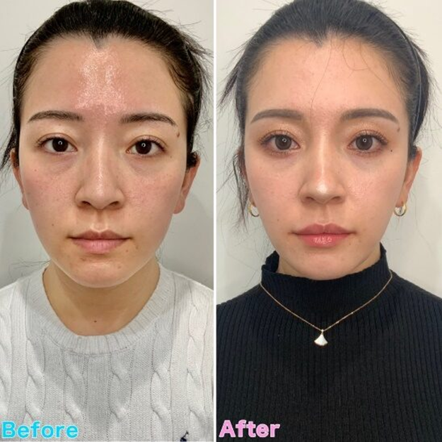 Lip Shaping Case Examples befor&after1