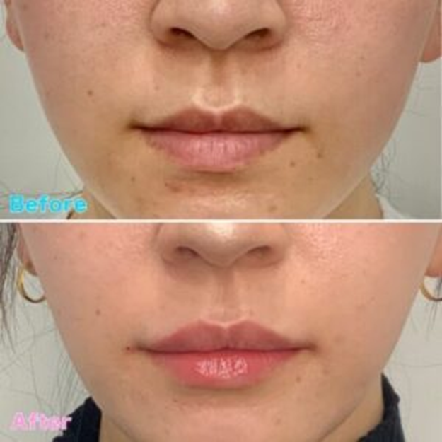 Lip Shaping Case Examples befor&after２