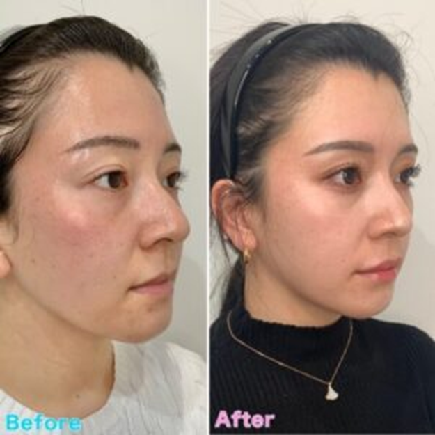 Lip Shaping Case Examples befor&after3