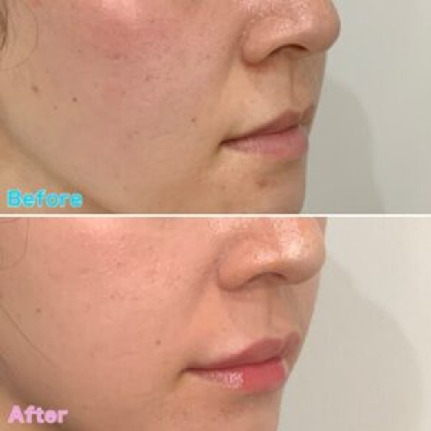 Lip Shaping Case Examples befor&after4