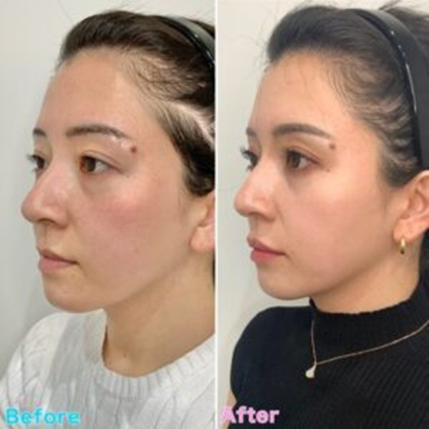 Lip Shaping Case Examples befor&after5