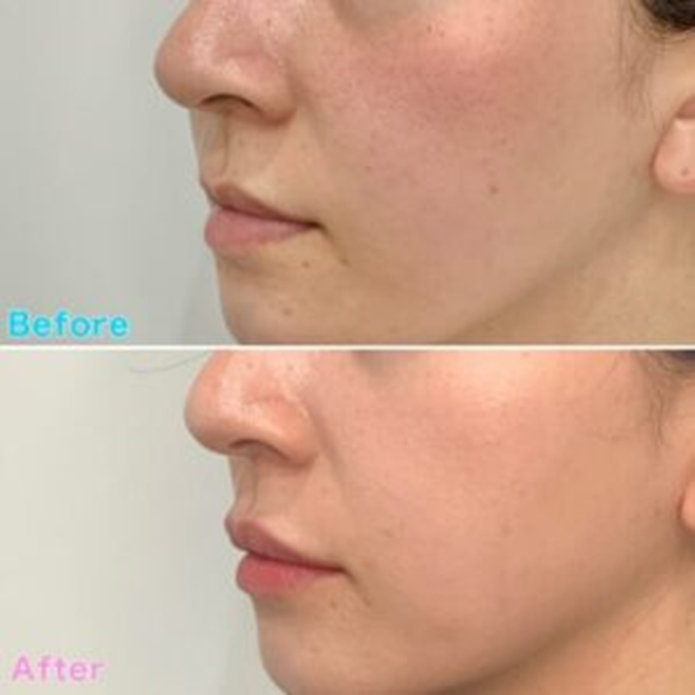 Lip Shaping Case Examples befor&after6