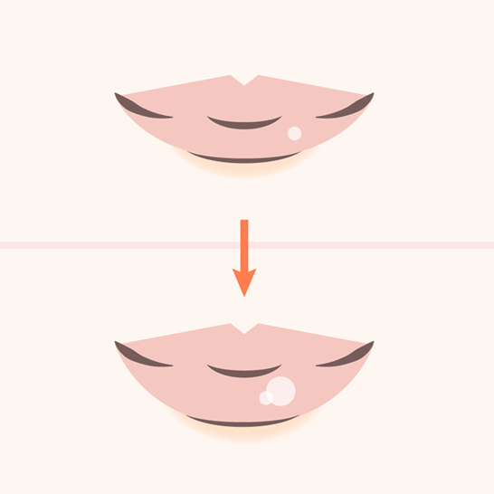 Lip Augmentation