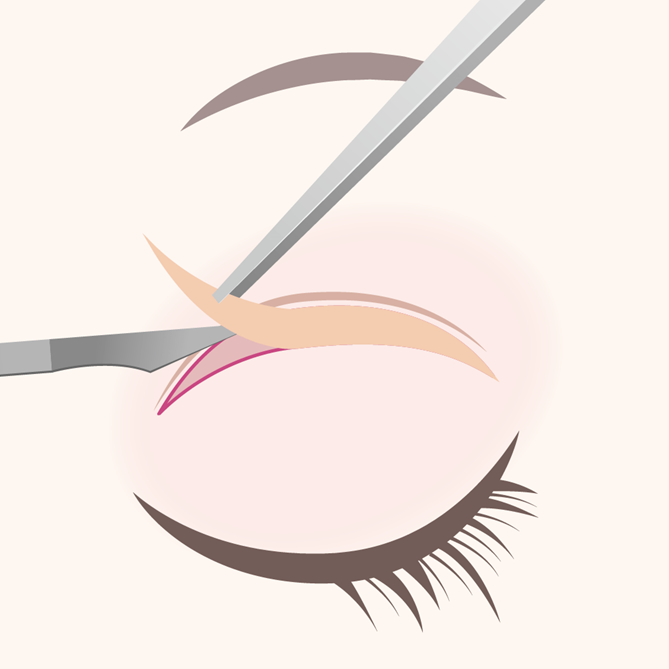 Double Eyelid Surgery