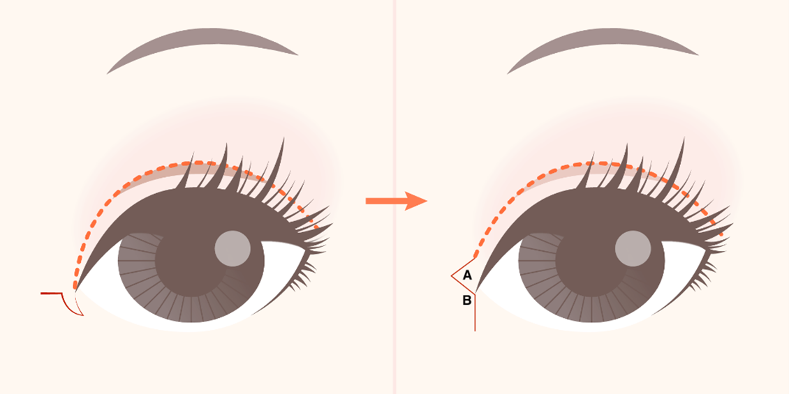 Inner Canthoplasty