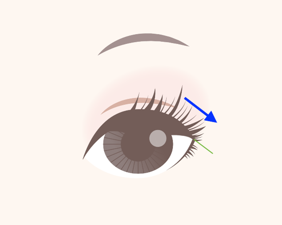Lateral Canthoplasty
