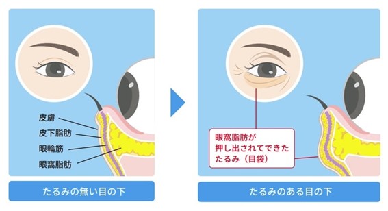 Lower eyelid sagging