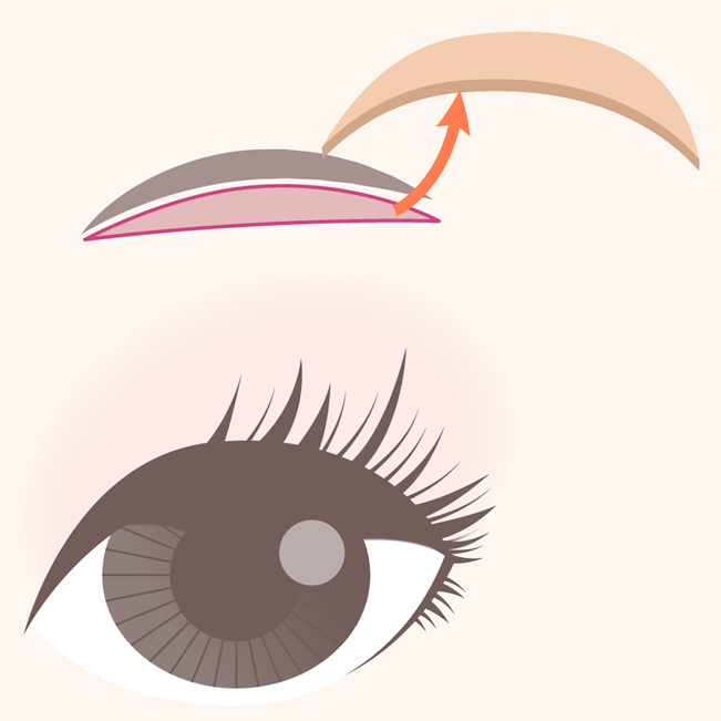 Upper Eyelid Lift (Brow Lift)