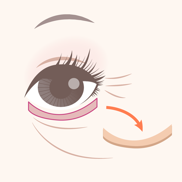 Lower Eyelid Blepharoplasty