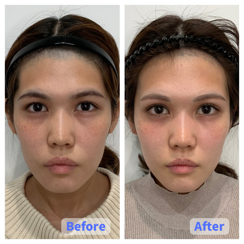 Case 1: Under-Eye Sagging Removal (Full Face)