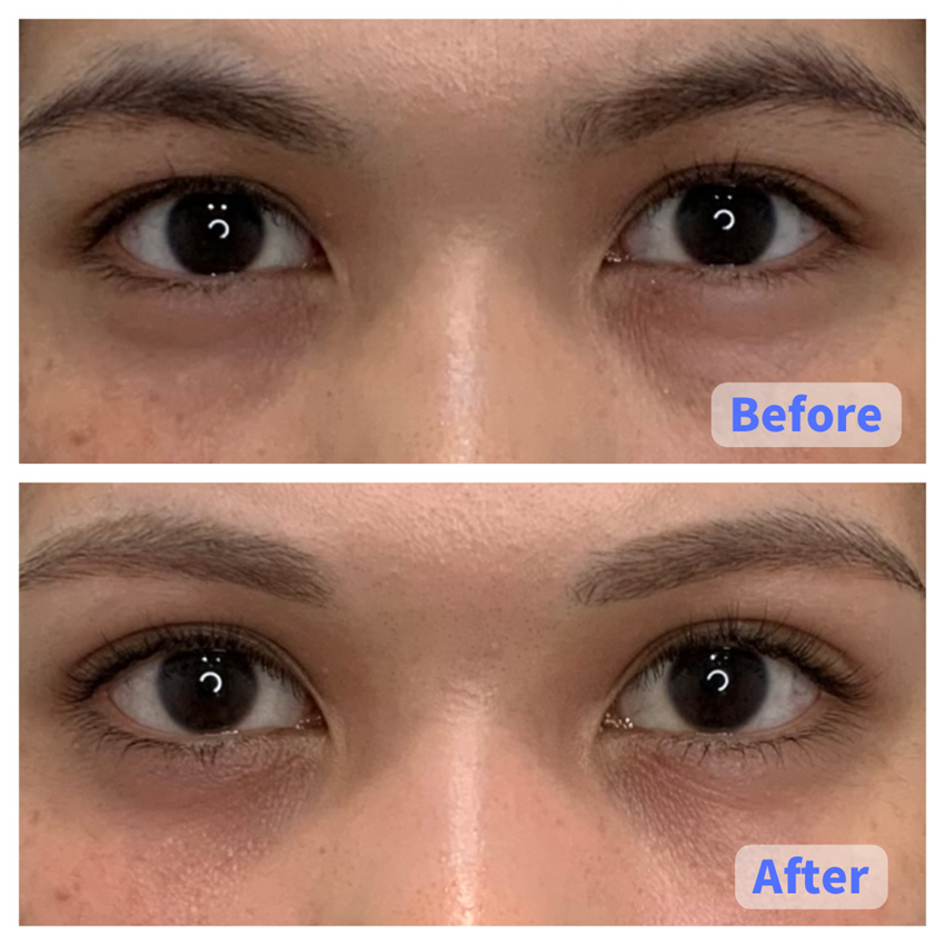 Case 1: Lower Eyelid Sagging Removal (Eye Area)