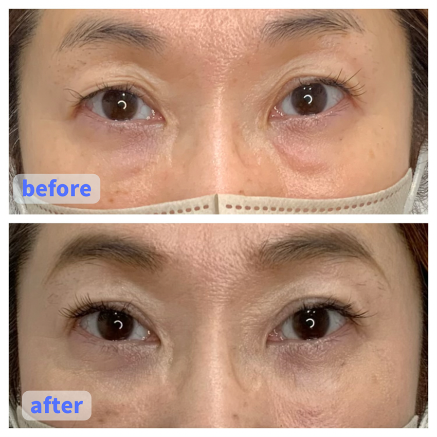 Case 2: Lower Eyelid Sagging Removal (Eye Area)